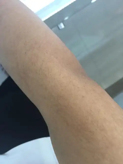 我手臂上这些黑斑是怎么回事呀.就右手有.左手没有