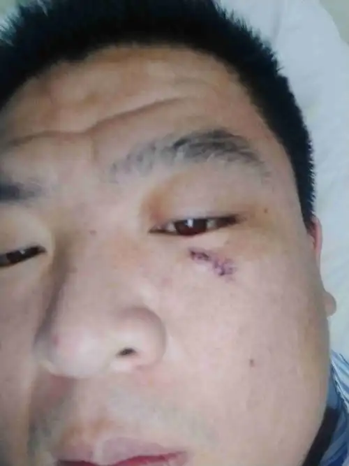 和别人打架,右眼睛下面,被酒瓶打伤了一个两公分的