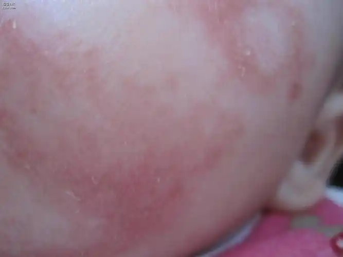 婴儿湿疹奶癣宝宝之父母湿疹手册-低敏奶粉大全-添激素排行榜