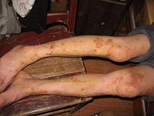 性病图片_性病症状表现图片大全_有来医生