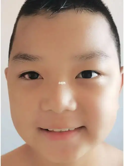 斜视术后第八天,今天可以洗脸了,眼睛还是有点红,不过会越来越好的