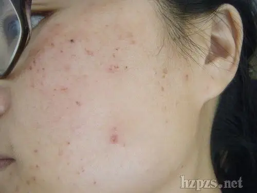 我们身边的hpv人乳头状瘤病毒