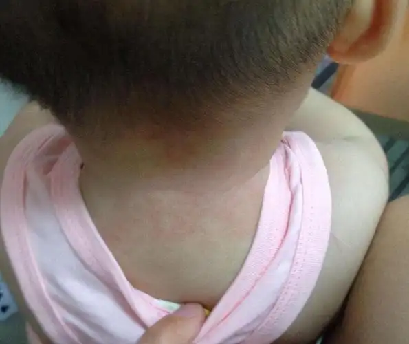 婴儿长痱子怎么办?是什么原因?