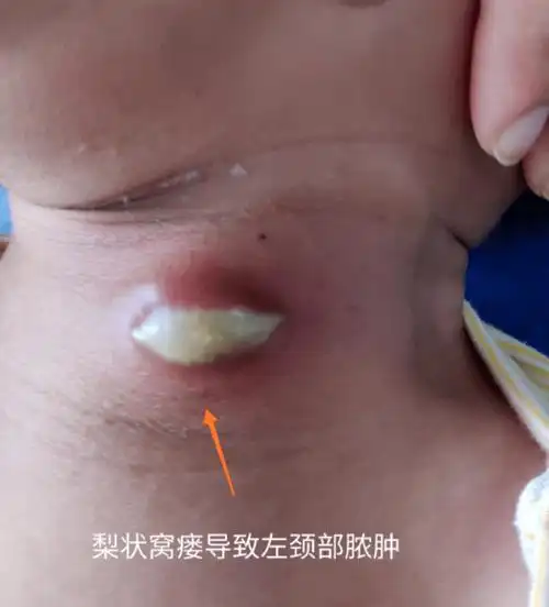 7岁男孩脖子长出鹌鹑蛋医生切开全是脓这种病常见却极易误诊