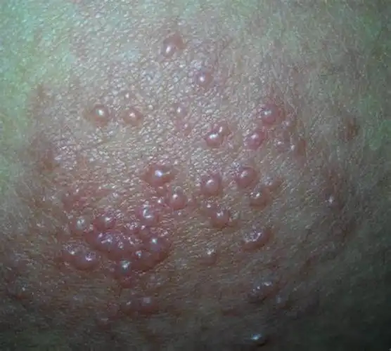 红痱:成批出现针头大小密集丘疹,丘疱疹,周围有红晕;脓痱:表现为痱子