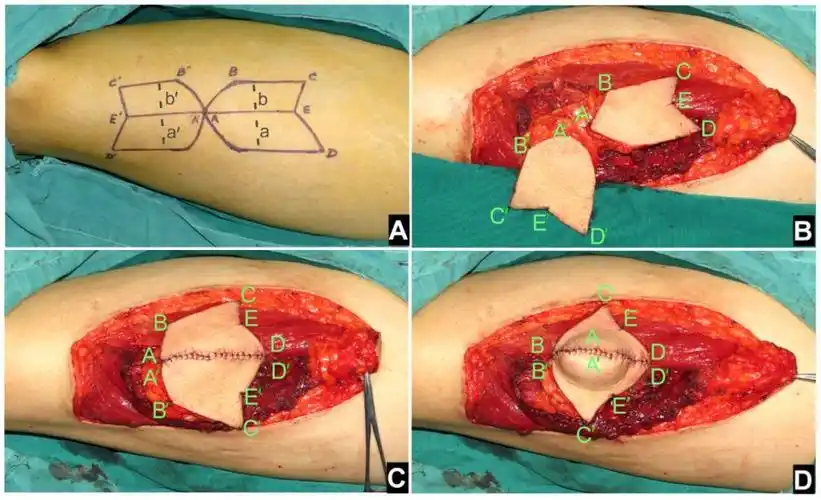 文献导读基于解剖学五点八线区段技术用于精确次全舌重建