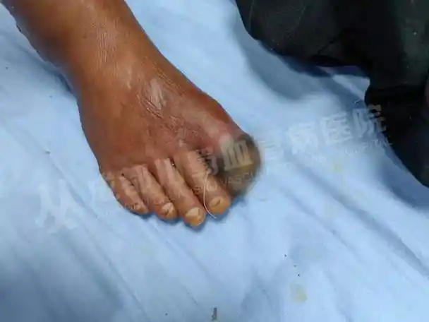 脉管炎 | 从疼痛到病变,如何守护你的"生命线"?_活动_症状_血管