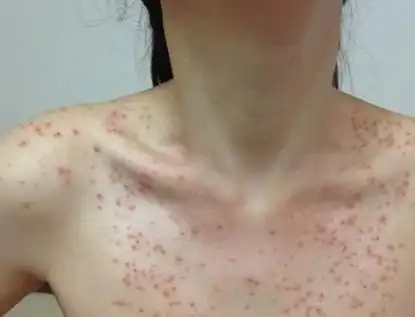 传染性软疣是由传染性软疣病毒引起,是一种病毒感染,所以自愈可能性是