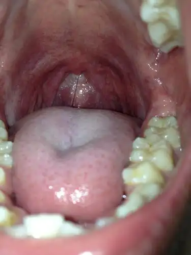 我这扁桃体发炎没?嗓子不痛不痒,就是稍微有点痰.需要吃咽炎片吗