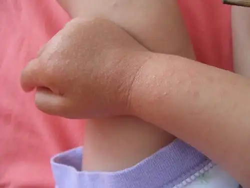 求助是摩擦性湿疹吗