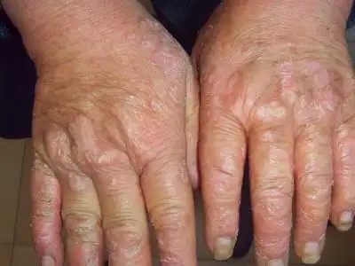 大家看看这是什么病?