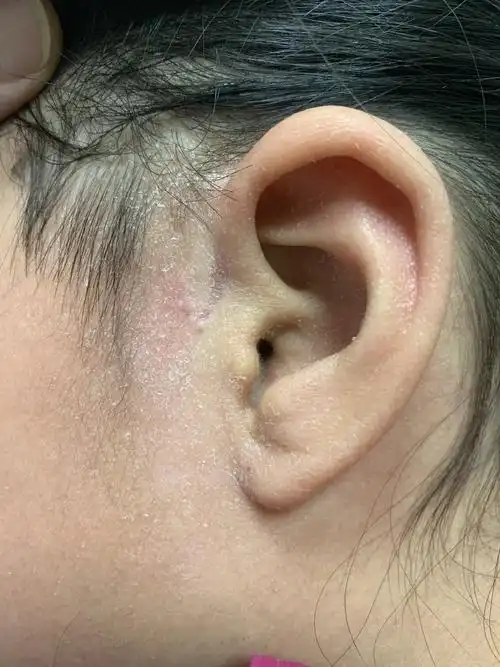 耳前瘘管微创美容术后指南