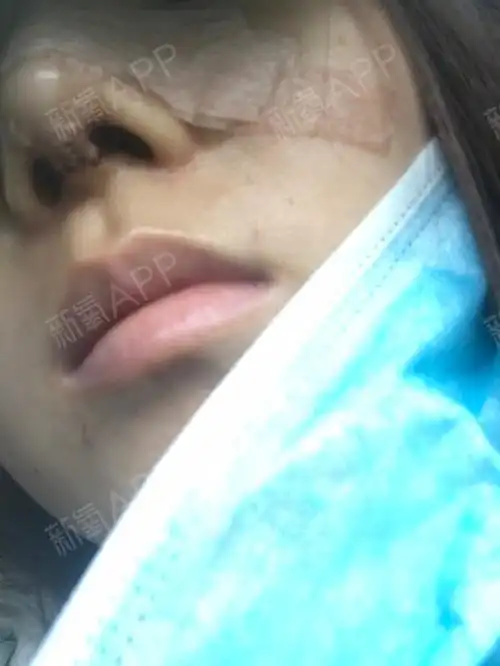做了鼻部多项,鼻小柱伤口处起了两个泡,是为什么