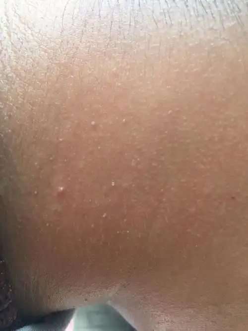 脖子两侧上起了好多像粉刺,又像肉灸的东西的,不疼不痒的,就是出汗多