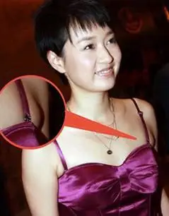 副乳危害大!减副乳3大秘诀