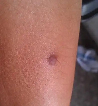 脸上长有扁平疣!