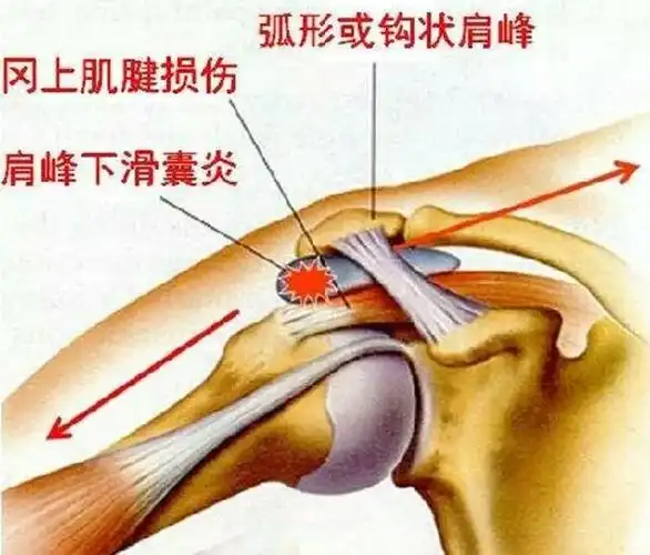聚享体育李教练与你说说运动损伤之肩峰撞击症