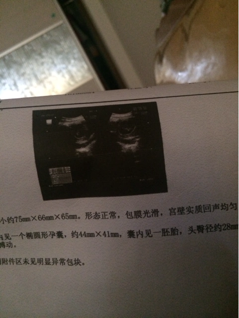 b超孕囊显示椭圆形的都是生女儿多吗?