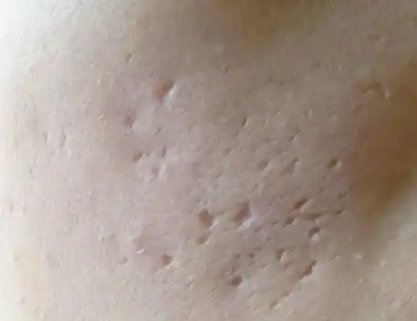 悦美app医美名医录深度解析激光去痘疤