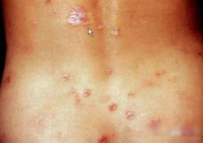 女性梅毒症状图片大全_有来医生