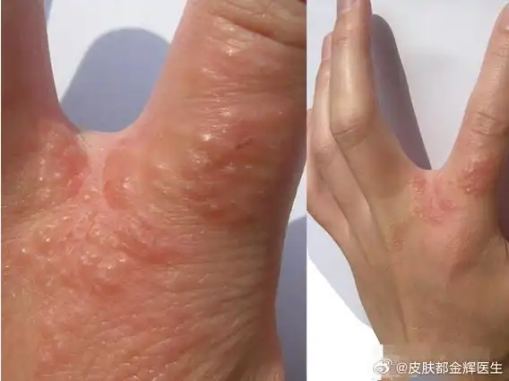 湿疹颜色较淡,透明,挤破后甚至会流清水出来,瘙痒难耐,常会出现在手指