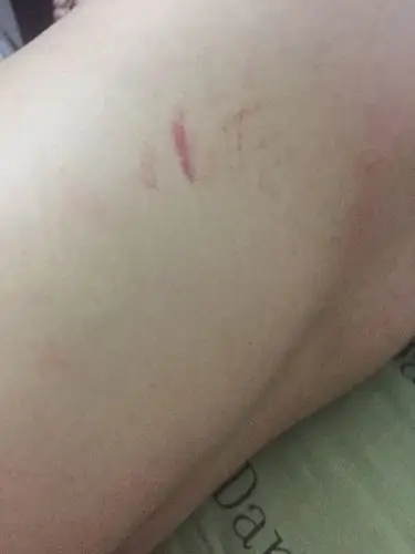 老公身上的,帮我看看这是什么?按这印是什么时候有的,拜托帮我分析下