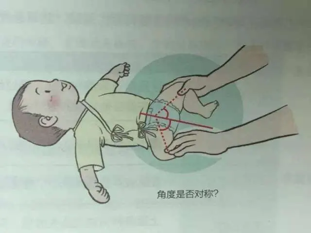 腿纹不对称是因为胖?别对孩子这么不上心了