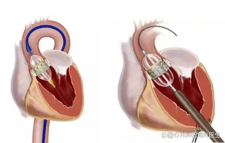 生物瓣膜和机械瓣膜哪个比较好?