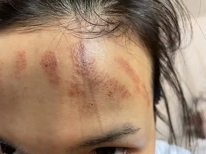 消费者称做光子嫩肤额头被灼伤,涉事医院:复诊时视情况修复_吕女士