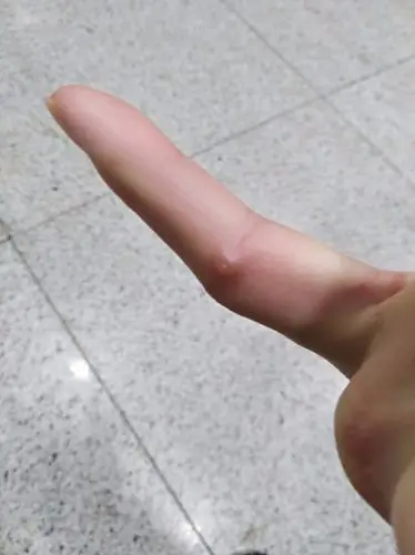 手上起了个半透明的小疙瘩 按压会疼