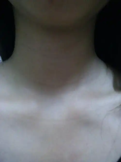 怀孕差不多4个月了,突然发现脖子上有几条痕,一圈一圈的,怎么回事?
