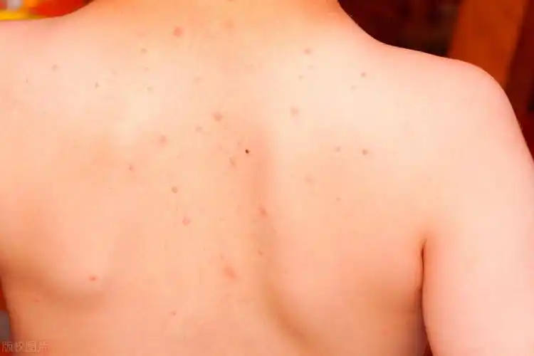 提醒:身体皮肤出现这几个状况,要及时注意,或是艾滋发出的信号