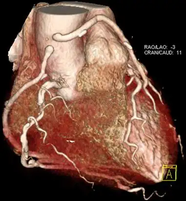 冠脉ct检查:冠心病的有效检查手段-放射科-健康科普-川北医学院附属