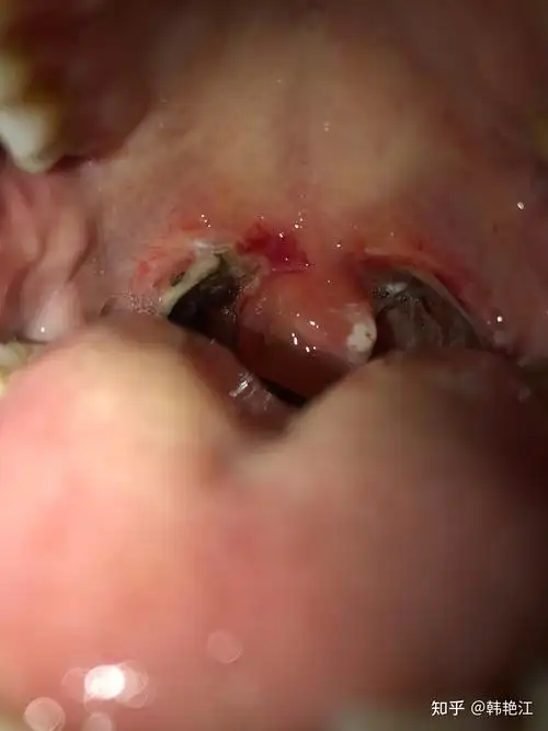 北京做扁桃体手术的经历,术后6天出血 - 知乎