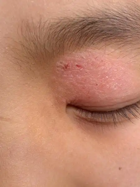 十岁儿童,左眼上眼皮一皮损,是牛皮癣么?