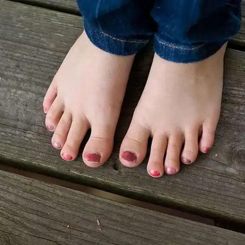 但医生说"这可不是件好事",原来希腊脚容易出现这样的病变.