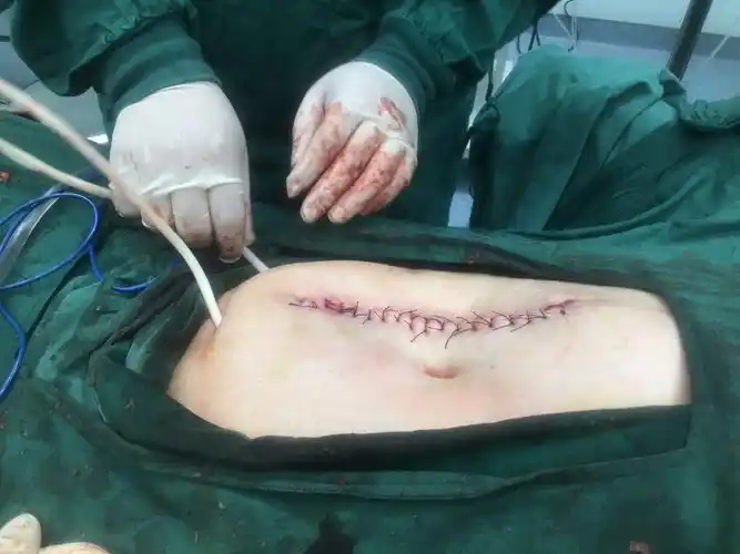 腹部无刀口的直肠癌根治术 微创无痛