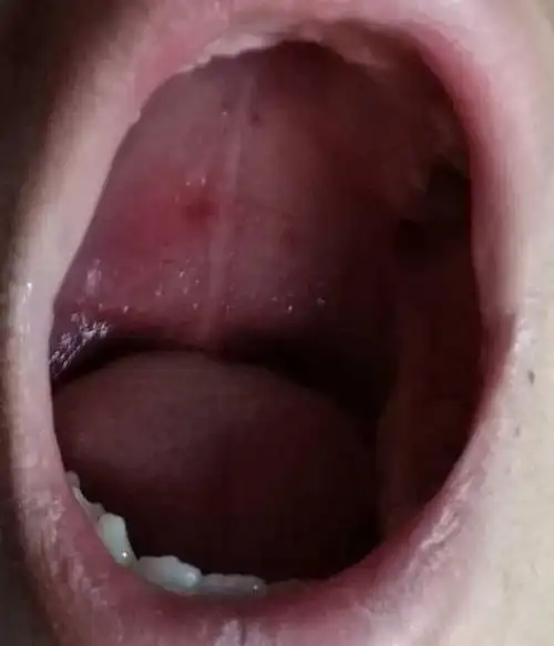 口腔上颚长肿块,有些硬的,一个消了又长一个,怎么才能好