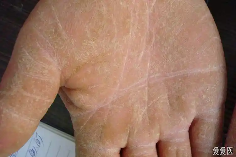 看图诊断43角化型湿疹