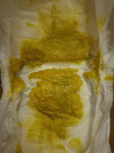 三个月小宝宝拉这样的屎正常么?是蛋花状么