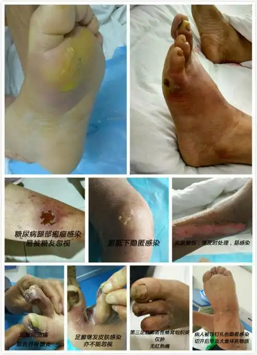 你的脚距离糖尿病足有多远?看图就知道了!