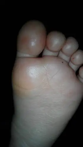 问:三岁宝宝手掌脚掌有红点而且很痒,医生说是过敏