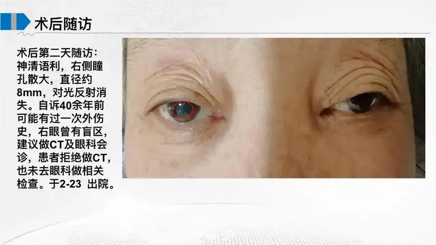 让人虚惊一场的瞳孔散大围术期瞳孔变化及临床意义