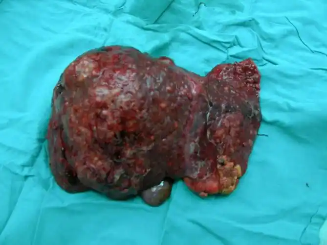 肝硬化中晚期危险吗