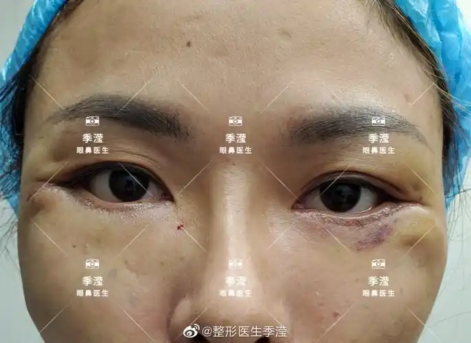 下眼睑退缩外翻矫正案例时程一年左右