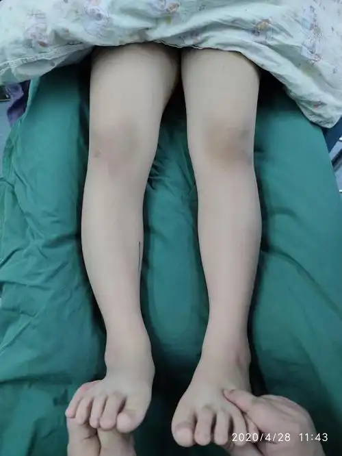 创伤性膝外翻畸形的手术矫正