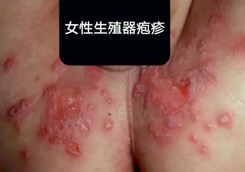 男性生殖疱疹的症状发生在阴茎上.