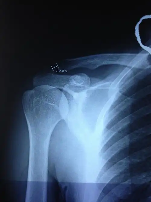 请问右肩锁关节半脱位能有多小几率能评上评残?