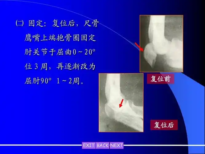 尺骨鹰嘴骨折ppt