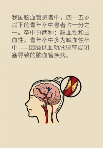 年纪轻轻别大意小心脑卒中
